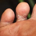 Stop Athlete’s Foot Now: What Is Athlete's Foot Fungus Between the Toes and How to Treat It