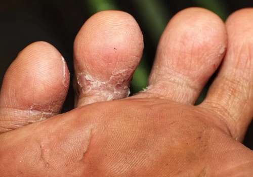 Stop Athlete’s Foot Now: What Is Athlete's Foot Fungus Between the Toes and How to Treat It